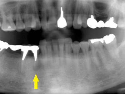 名古屋で実績のあるかすや歯科では難症例でも可能｜症例⑦-1