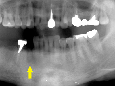 名古屋で実績のあるかすや歯科では難症例でも可能｜症例⑦-2