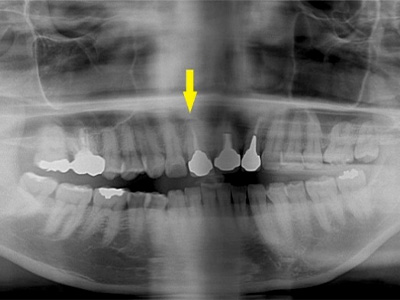 名古屋で実績のあるかすや歯科では難症例でも可能｜症例⑧-1