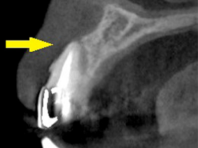 名古屋で実績のあるかすや歯科では難症例でも可能｜症例⑧-5