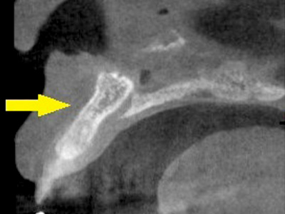 名古屋で実績のあるかすや歯科では難症例でも可能｜症例⑧-2