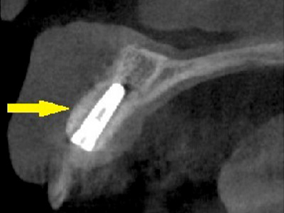 名古屋で実績のあるかすや歯科では難症例でも可能｜症例⑧-3