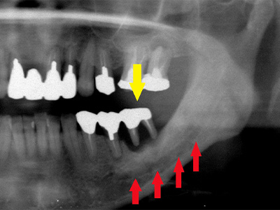 名古屋で実績のあるかすや歯科では難症例でも可能｜症例⑥-1