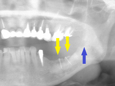 名古屋で実績のあるかすや歯科では難症例でも可能｜症例⑥-2