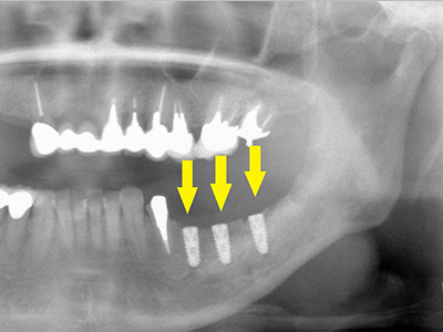 名古屋で実績のあるかすや歯科では難症例でも可能｜症例⑥-3
