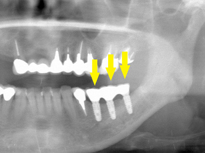 名古屋で実績のあるかすや歯科では難症例でも可能｜症例⑥-4