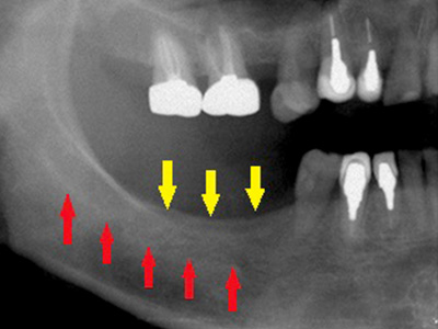 名古屋で実績のあるかすや歯科では難症例でも可能｜症例①-1