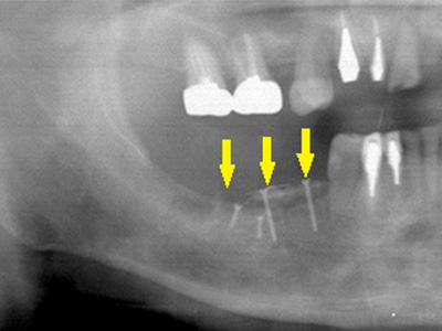 名古屋で実績のあるかすや歯科では難症例でも可能｜症例①-2