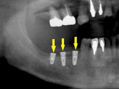 名古屋で実績のあるかすや歯科では難症例でも可能｜症例①-3