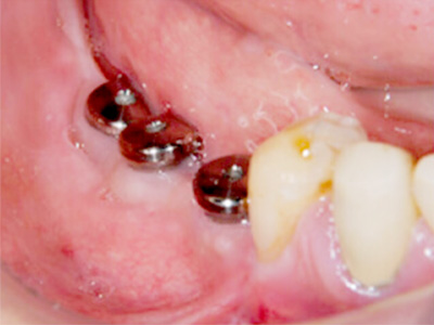 名古屋で実績のあるかすや歯科では難症例でも可能｜症例①-4
