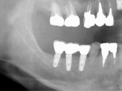 名古屋で実績のあるかすや歯科では難症例でも可能｜症例①-5