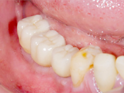 名古屋で実績のあるかすや歯科では難症例でも可能｜症例①-6