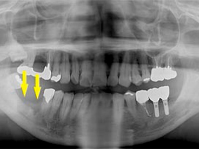 名古屋で実績のあるかすや歯科では難症例でも可能｜症例②-1
