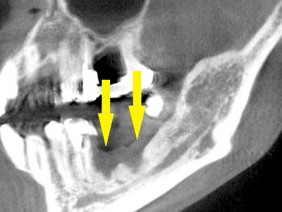 名古屋で実績のあるかすや歯科では難症例でも可能｜症例②-2