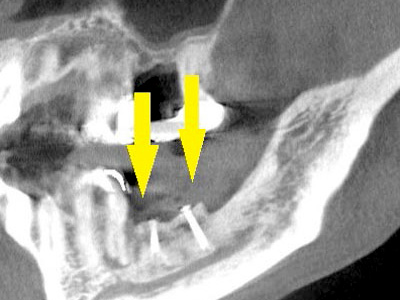 名古屋で実績のあるかすや歯科では難症例でも可能｜症例②-4