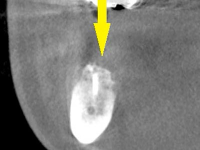 名古屋で実績のあるかすや歯科では難症例でも可能｜症例②-5