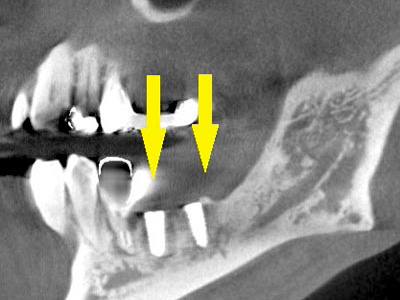 名古屋で実績のあるかすや歯科では難症例でも可能｜症例②-6