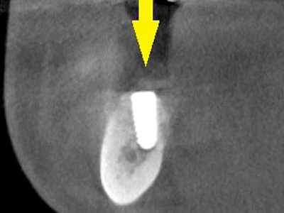 名古屋で実績のあるかすや歯科では難症例でも可能｜症例②-7
