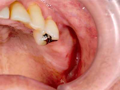 名古屋で実績のあるかすや歯科では難症例でも可能｜症例③-1
