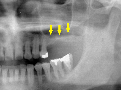 名古屋で実績のあるかすや歯科では難症例でも可能｜症例③-2