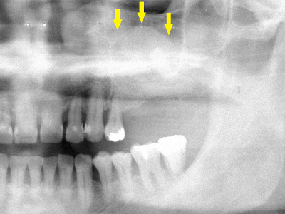 名古屋で実績のあるかすや歯科では難症例でも可能｜症例③-3
