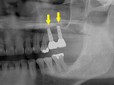名古屋で実績のあるかすや歯科では難症例でも可能｜症例③-4
