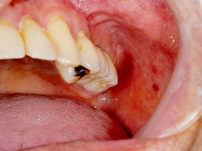 名古屋で実績のあるかすや歯科では難症例でも可能｜症例③-5