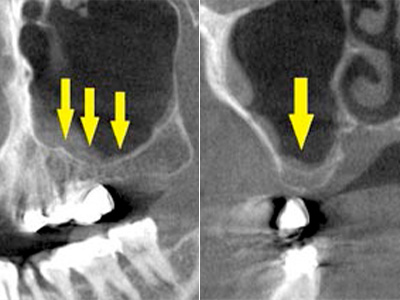 名古屋で実績のあるかすや歯科では難症例でも可能｜症例④-2
