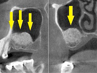 名古屋で実績のあるかすや歯科では難症例でも可能｜症例④-3