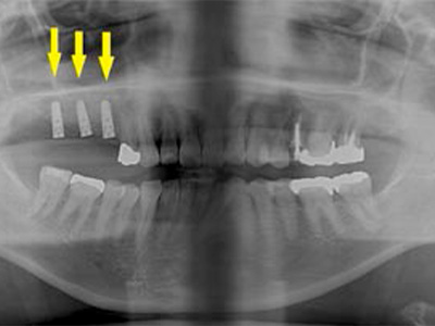 名古屋で実績のあるかすや歯科では難症例でも可能｜症例④-4