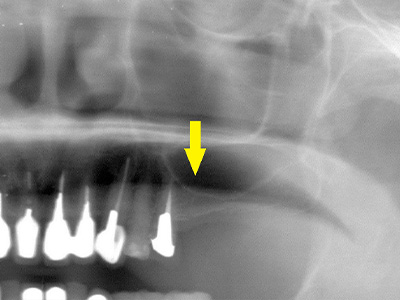 名古屋で実績のあるかすや歯科では難症例でも可能｜症例⑤-1