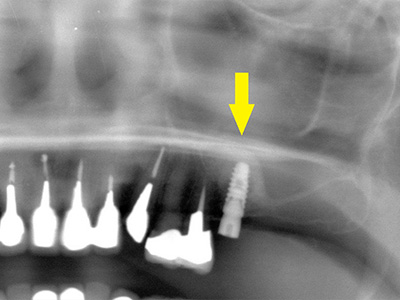 名古屋で実績のあるかすや歯科では難症例でも可能｜症例⑤-2