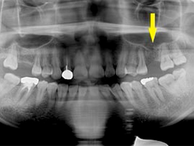 名古屋で実績のあるかすや歯科では難症例でも可能｜症例⑤-1