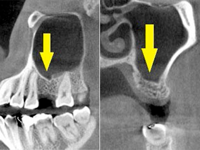 名古屋で実績のあるかすや歯科では難症例でも可能｜症例⑤-2