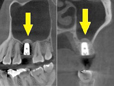 名古屋で実績のあるかすや歯科では難症例でも可能｜症例⑤-3