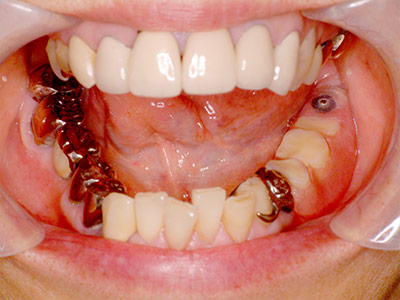 流れ④｜実績のある名医で安心の前処置