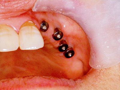 流れ⑥｜実績のある名医で納得の治癒期間