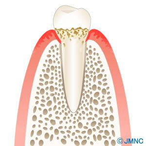 実績のあるかすや歯科の抜歯即時埋入術
