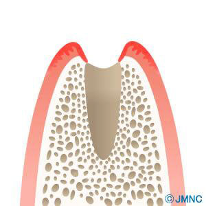 実績のあるかすや歯科の抜歯即時埋入術
