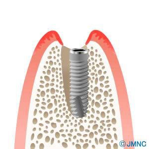 実績のあるかすや歯科の抜歯即時埋入術