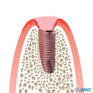 実績のあるかすや歯科の抜歯即時埋入術