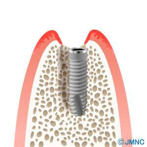 実績のあるかすや歯科の抜歯即時埋入術