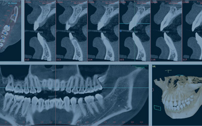 名古屋のかすや歯科で安心して行うためのCT・レントゲン写真