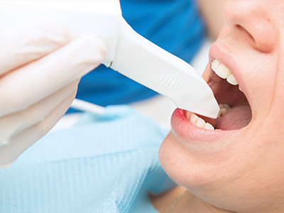 名古屋でストレス少なく行う口腔内スキャナー