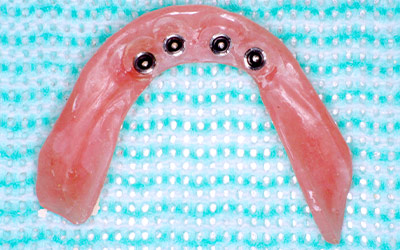 義歯の負担を軽減し安心の費用でご提供