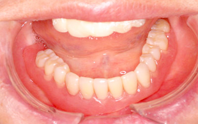 義歯の負担を軽減し安心の費用でご提供