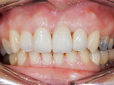 名古屋で実績のある名医による費用を抑えた症例①