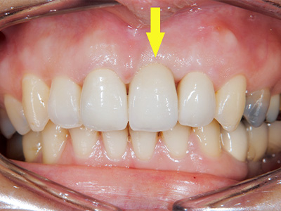 名古屋で実績のある名医による費用を抑えた症例①