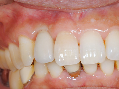 名古屋で実績のある名医による費用を抑えた症例②