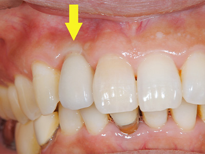 名古屋で実績のある名医による費用を抑えた症例②